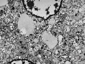 M, | newborn mitochondrial cardiomyopathy … autopsy sample from liver M, | newborn mitochondrial cardiomyopathy … autopsy sample from liver